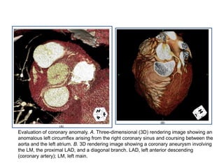 Evaluation of coronary anomaly. A. Three-dimensional (3D) rendering image showing an
anomalous left circumflex arising from the right coronary sinus and coursing between the
aorta and the left atrium. B. 3D rendering image showing a coronary aneurysm involving
the LM, the proximal LAD, and a diagonal branch. LAD, left anterior descending
(coronary artery); LM, left main.
 