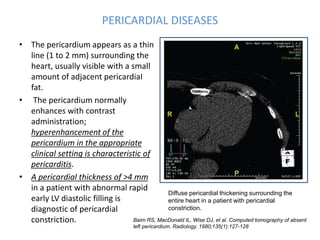 PERICARDIAL DISEASES
• The pericardium appears as a thin
line (1 to 2 mm) surrounding the
heart, usually visible with a small
amount of adjacent pericardiaI
fat.
• The pericardium normally
enhances with contrast
administration;
hyperenhancement of the
pericardium in the appropriate
clinical setting is characteristic of
pericarditis.
• A pericardial thickness of >4 mm
in a patient with abnormal rapid
early LV diastolic filling is
diagnostic of pericardial
constriction.
Diffuse pericardial thickening surrounding the
entire heart in a patient with pericardial
constriction.
Baim RS, MacDonald IL, Wise DJ, et al. Computed tomography of absent
left pericardium. Radiology. 1980;135(1):127-128
 