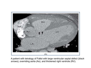 A patient with tetralogy of Fallot with large ventricular septal defect (black
arrows), overriding aorta (Ao), and thickened right ventricle (RV).
 