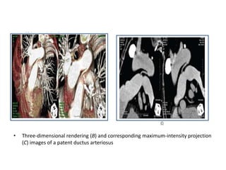 • Three-dimensional rendering (B) and corresponding maximum-intensity projection
(C) images of a patent ductus arteriosus
 