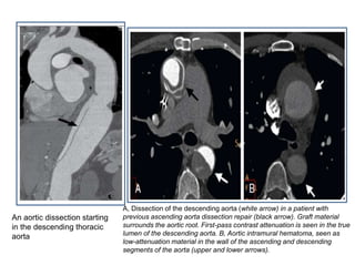An aortic dissection starting
in the descending thoracic
aorta
A, Dissection of the descending aorta (white arrow) in a patient with
previous ascending aorta dissection repair (black arrow). Graft material
surrounds the aortic root. First-pass contrast attenuation is seen in the true
lumen of the descending aorta. B, Aortic intramural hematoma, seen as
low-attenuation material in the wall of the ascending and descending
segments of the aorta (upper and lower arrows).
 
