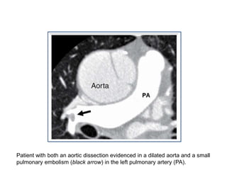 Patient with both an aortic dissection evidenced in a dilated aorta and a small
pulmonary embolism (black arrow) in the left pulmonary artery (PA).
 