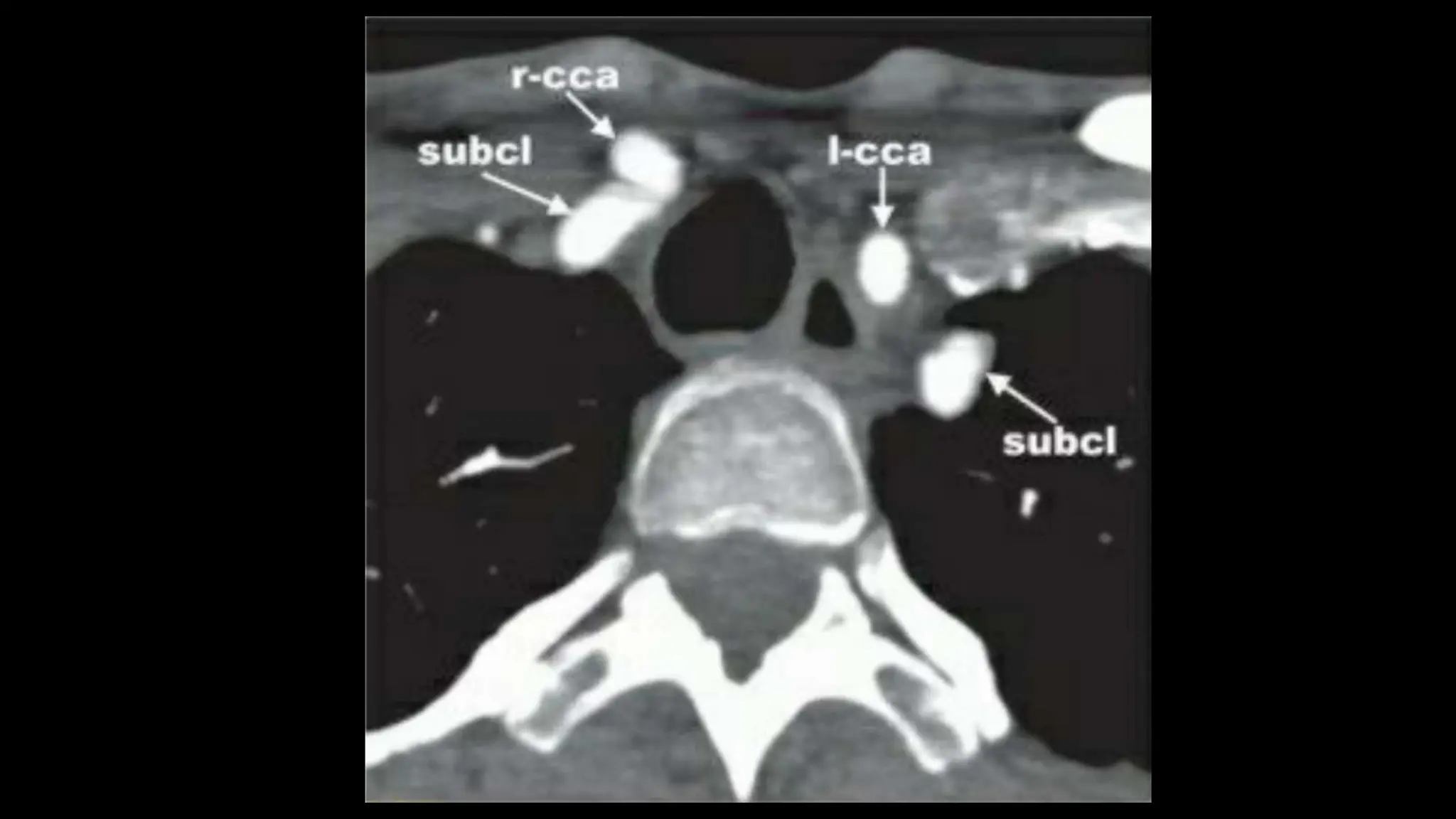 Toheed Ct Angio CT ANGIO 2.pptx by sms medical college jaipur | PPTX