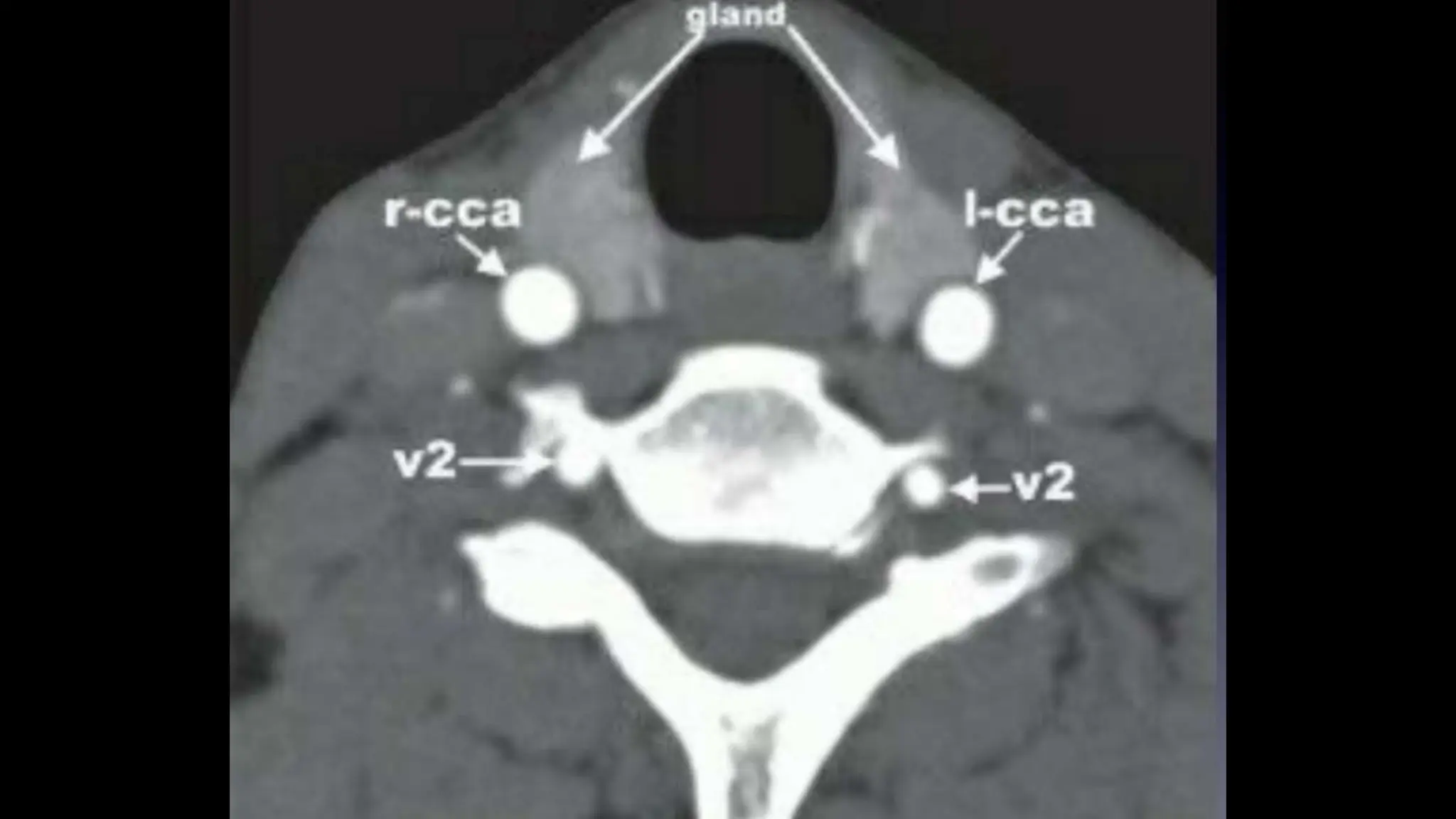 Toheed Ct Angio CT ANGIO 2.pptx by sms medical college jaipur | PPTX