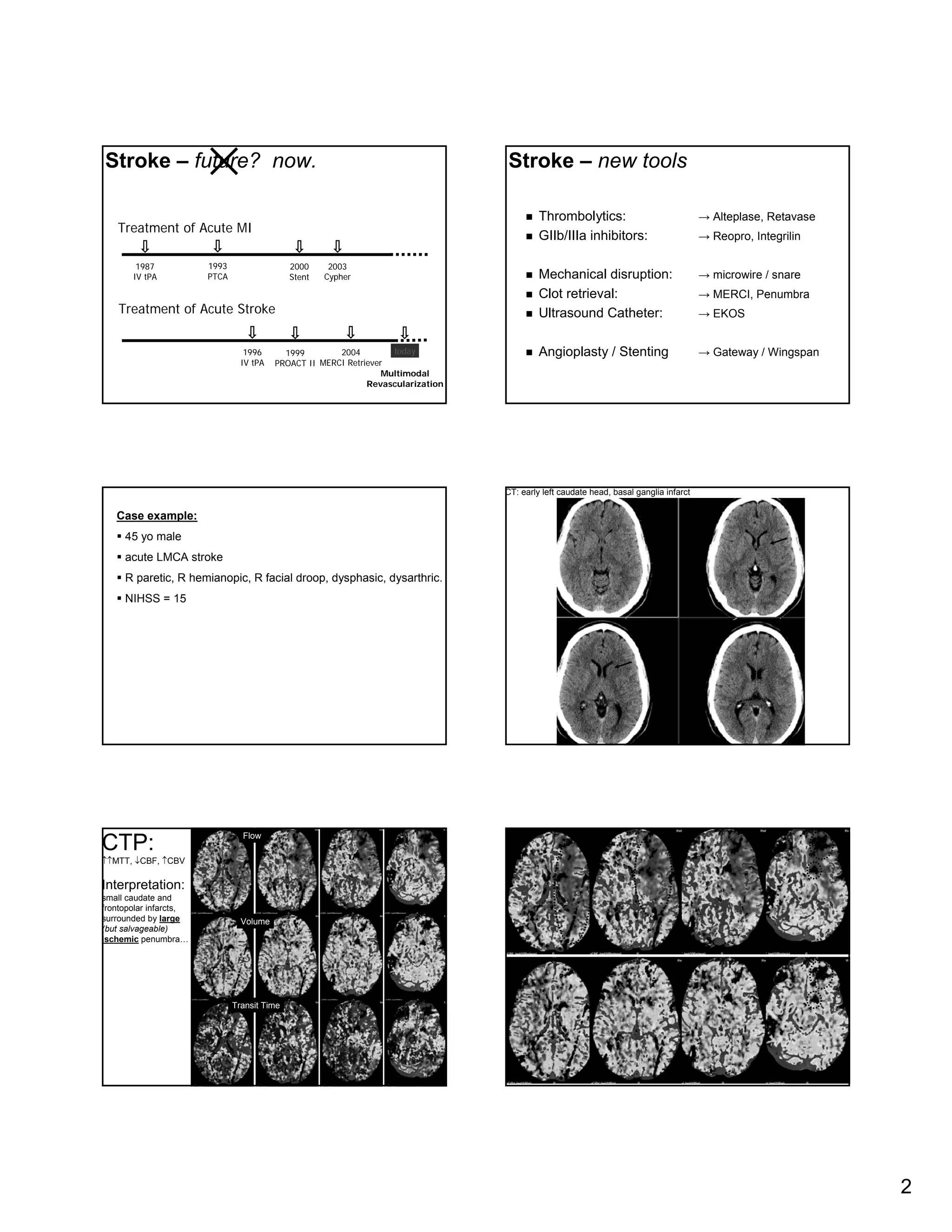 CT Angiography & CT Perfusion in Management of Acute Stroke | PDF