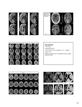 CT Angiography & CT Perfusion in Management of Acute Stroke | PDF