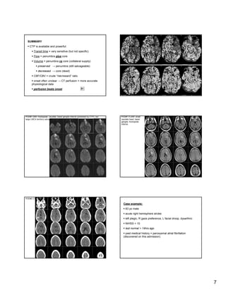 CT Angiography & CT Perfusion in Management of Acute Stroke | PDF