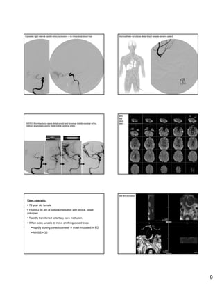 CT Angiography & CT Perfusion in Management of Acute Stroke | PDF