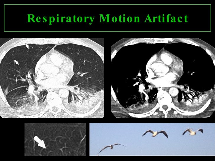 CTA OF PULMONARY EMBOLISM