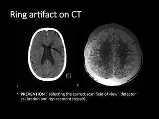 ct artefacts detailed explanation with images | PPTX