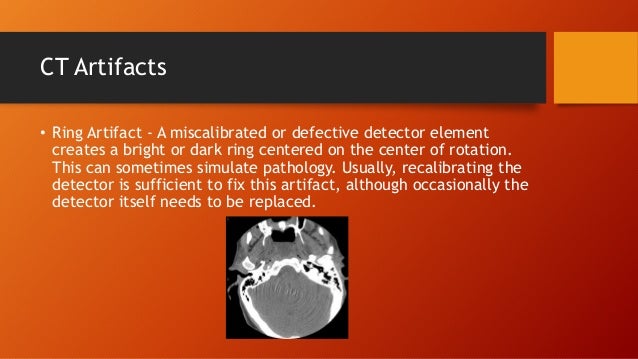Ct Ring Detector Artifact Ct Ring Detector Artifact