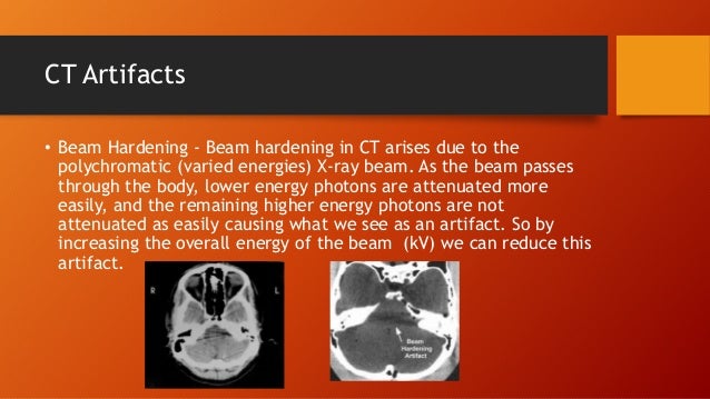 Ct Ring Artifact Reduction Ct Ring Artifact Reduction