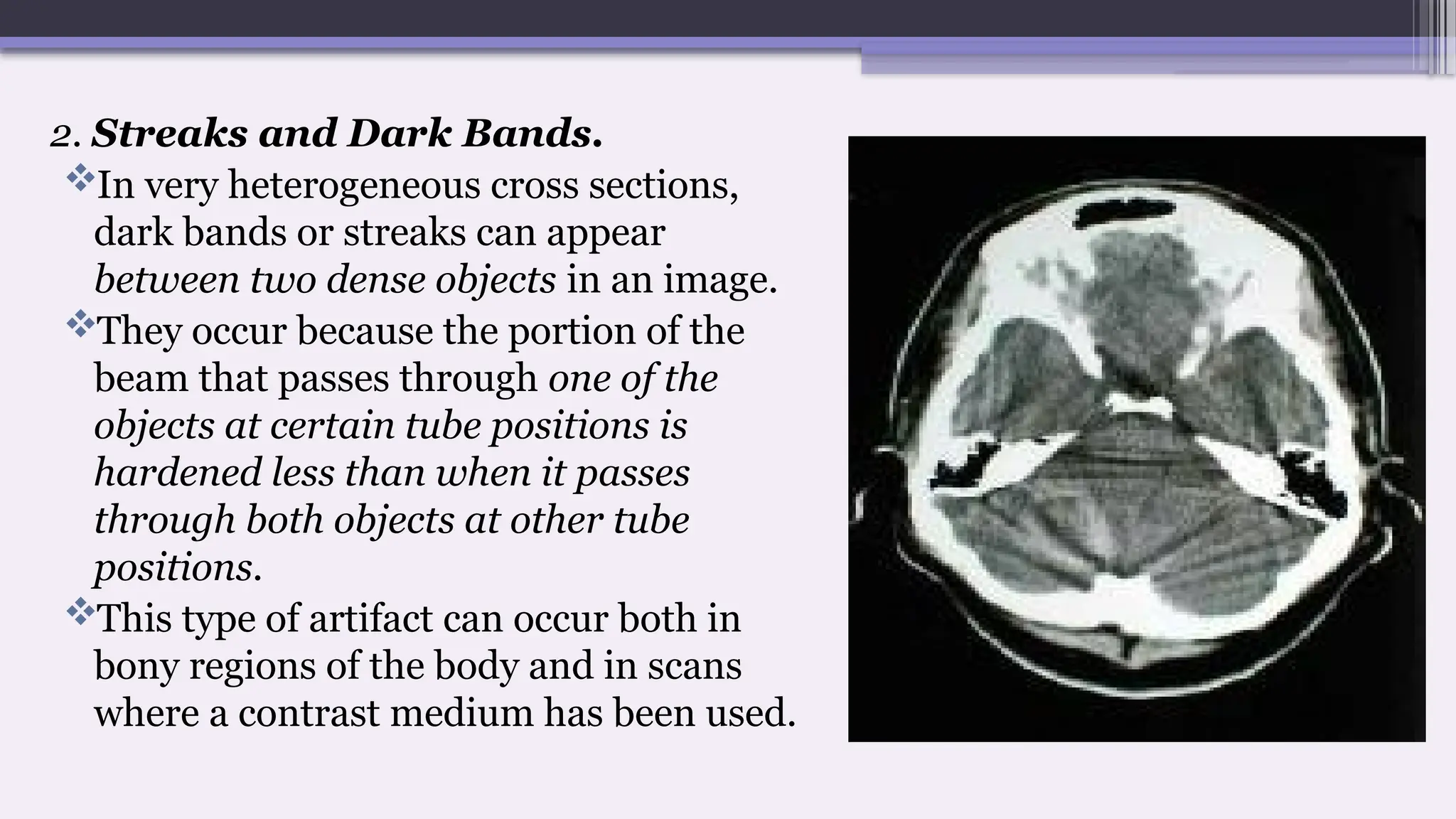 2. Streaks and Dark Bands.
In very heterogeneous cross sections,
dark bands or streaks can appear
between two dense objects in an image.
They occur because the portion of the
beam that passes through one of the
objects at certain tube positions is
hardened less than when it passes
through both objects at other tube
positions.
This type of artifact can occur both in
bony regions of the body and in scans
where a contrast medium has been used.
 