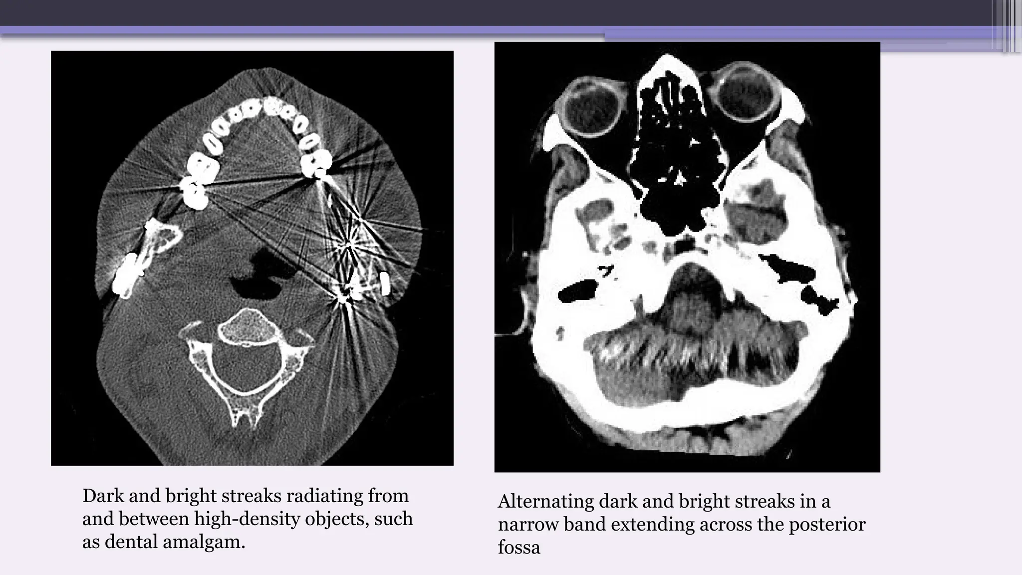 Dark and bright streaks radiating from
and between high-density objects, such
as dental amalgam.
Alternating dark and bright streaks in a
narrow band extending across the posterior
fossa
 