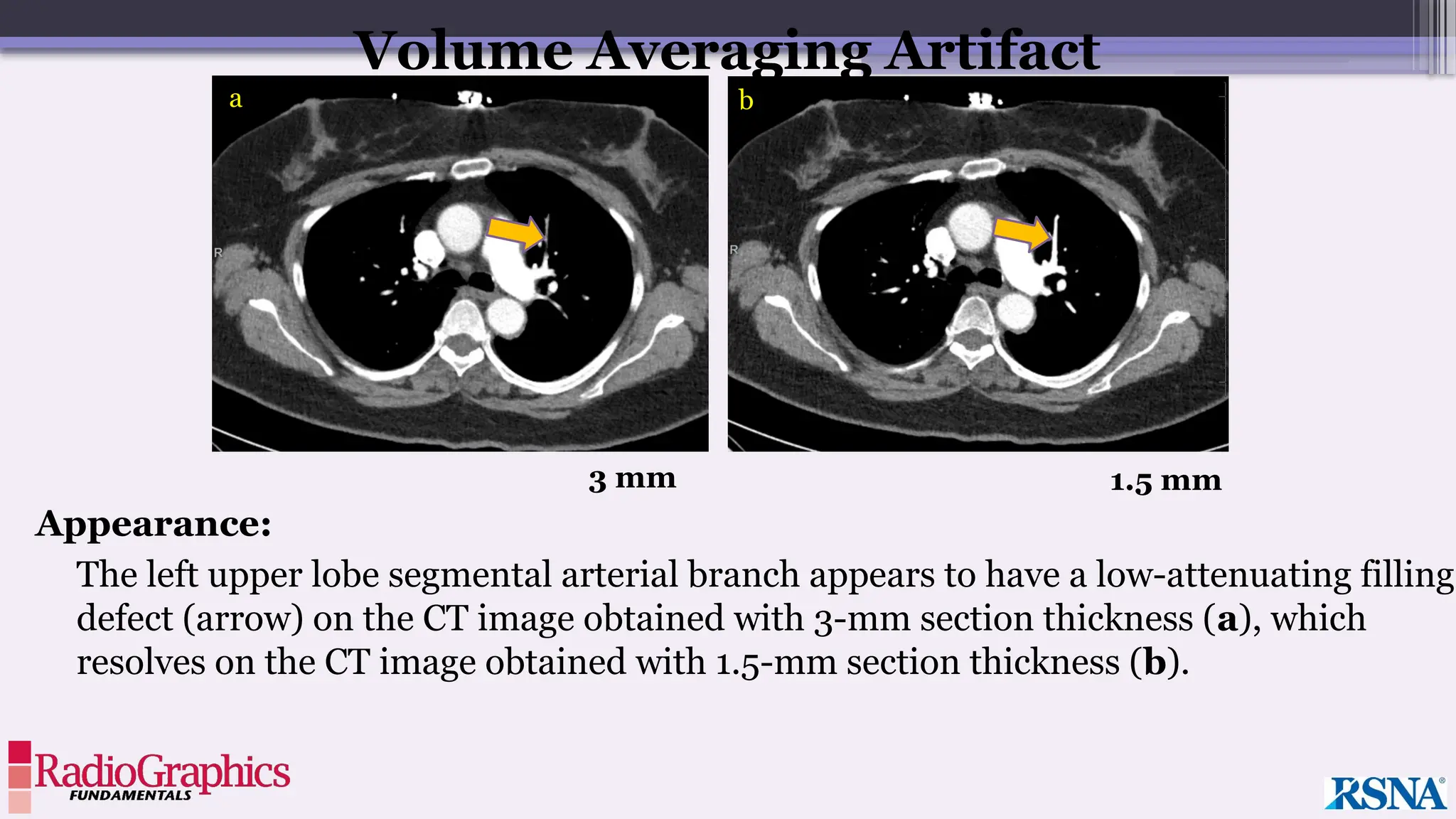 Appearance:
The left upper lobe segmental arterial branch appears to have a low-attenuating filling
defect (arrow) on the CT image obtained with 3-mm section thickness (a), which
resolves on the CT image obtained with 1.5-mm section thickness (b).
Volume Averaging Artifact
3 mm 1.5 mm
a b
 
