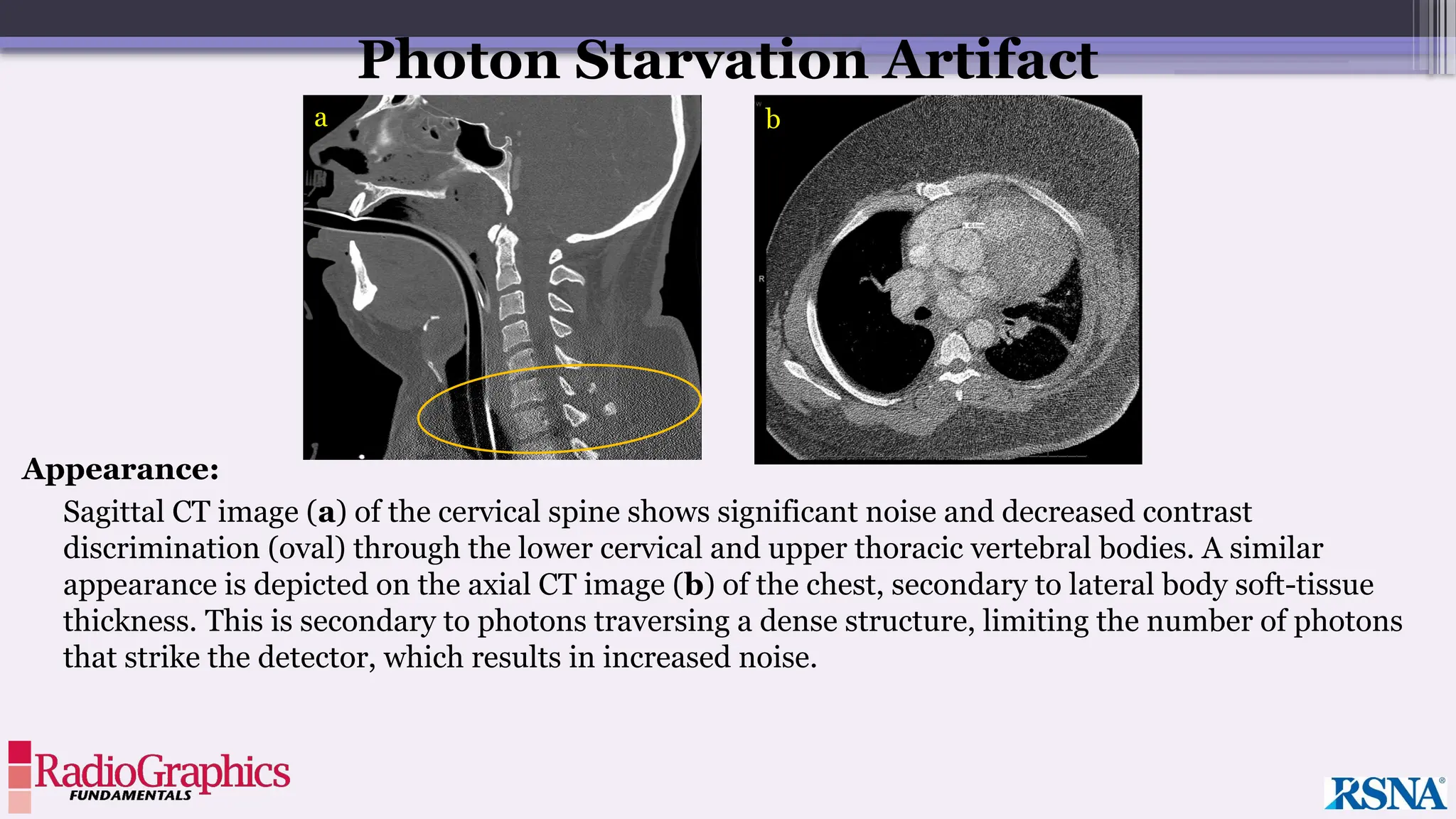 Appearance:
Sagittal CT image (a) of the cervical spine shows significant noise and decreased contrast
discrimination (oval) through the lower cervical and upper thoracic vertebral bodies. A similar
appearance is depicted on the axial CT image (b) of the chest, secondary to lateral body soft-tissue
thickness. This is secondary to photons traversing a dense structure, limiting the number of photons
that strike the detector, which results in increased noise.
Photon Starvation Artifact
a b
 
