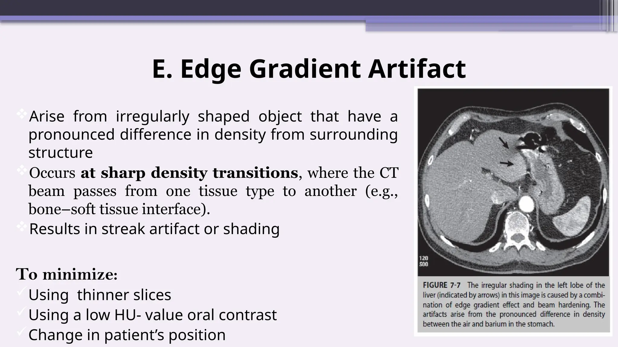 E. Edge Gradient Artifact
Arise from irregularly shaped object that have a
pronounced difference in density from surrounding
structure
Occurs at sharp density transitions, where the CT
beam passes from one tissue type to another (e.g.,
bone–soft tissue interface).
Results in streak artifact or shading
To minimize:
Using thinner slices
Using a low HU- value oral contrast
Change in patient’s position
 