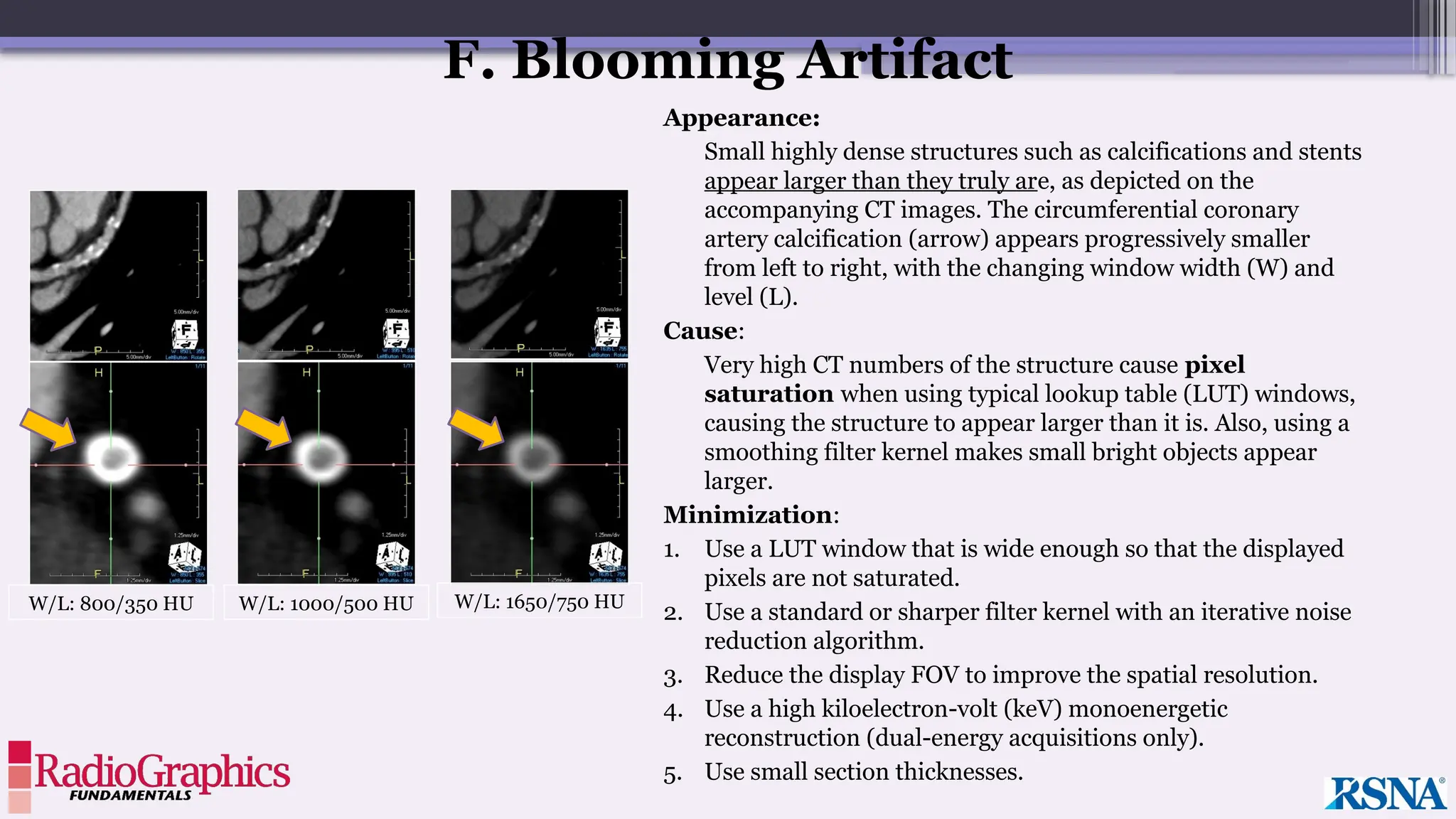 Appearance:
Small highly dense structures such as calcifications and stents
appear larger than they truly are, as depicted on the
accompanying CT images. The circumferential coronary
artery calcification (arrow) appears progressively smaller
from left to right, with the changing window width (W) and
level (L).
Cause:
Very high CT numbers of the structure cause pixel
saturation when using typical lookup table (LUT) windows,
causing the structure to appear larger than it is. Also, using a
smoothing filter kernel makes small bright objects appear
larger.
Minimization:
1. Use a LUT window that is wide enough so that the displayed
pixels are not saturated.
2. Use a standard or sharper filter kernel with an iterative noise
reduction algorithm.
3. Reduce the display FOV to improve the spatial resolution.
4. Use a high kiloelectron-volt (keV) monoenergetic
reconstruction (dual-energy acquisitions only).
5. Use small section thicknesses.
W/L: 800/350 HU W/L: 1000/500 HU W/L: 1650/750 HU
F. Blooming Artifact
 