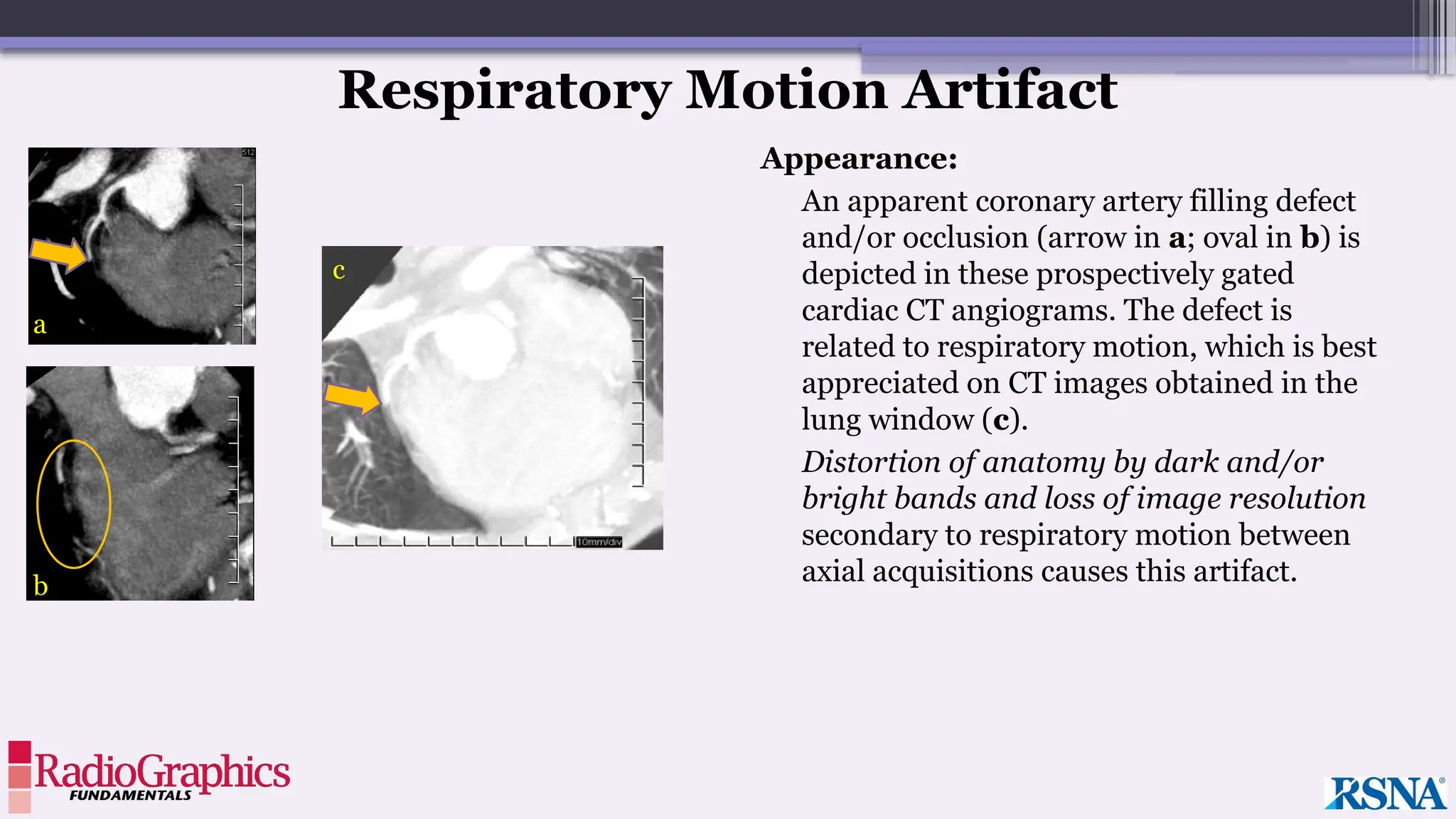 Appearance:
An apparent coronary artery filling defect
and/or occlusion (arrow in a; oval in b) is
depicted in these prospectively gated
cardiac CT angiograms. The defect is
related to respiratory motion, which is best
appreciated on CT images obtained in the
lung window (c).
Distortion of anatomy by dark and/or
bright bands and loss of image resolution
secondary to respiratory motion between
axial acquisitions causes this artifact.
Respiratory Motion Artifact
a
b
c
 