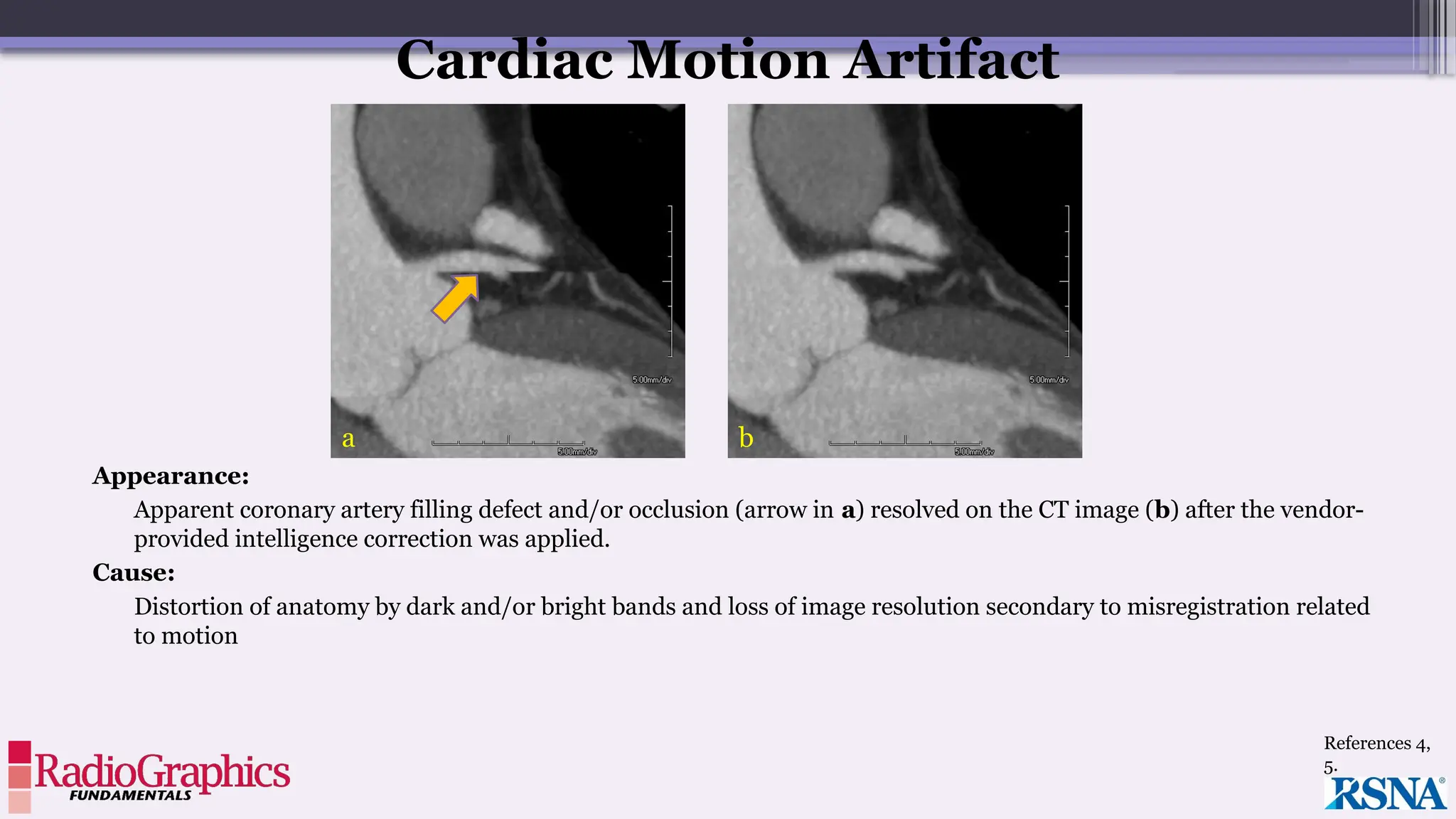 Appearance:
Apparent coronary artery filling defect and/or occlusion (arrow in a) resolved on the CT image (b) after the vendor-
provided intelligence correction was applied.
Cause:
Distortion of anatomy by dark and/or bright bands and loss of image resolution secondary to misregistration related
to motion
Cardiac Motion Artifact
References 4,
5.
a b
 
