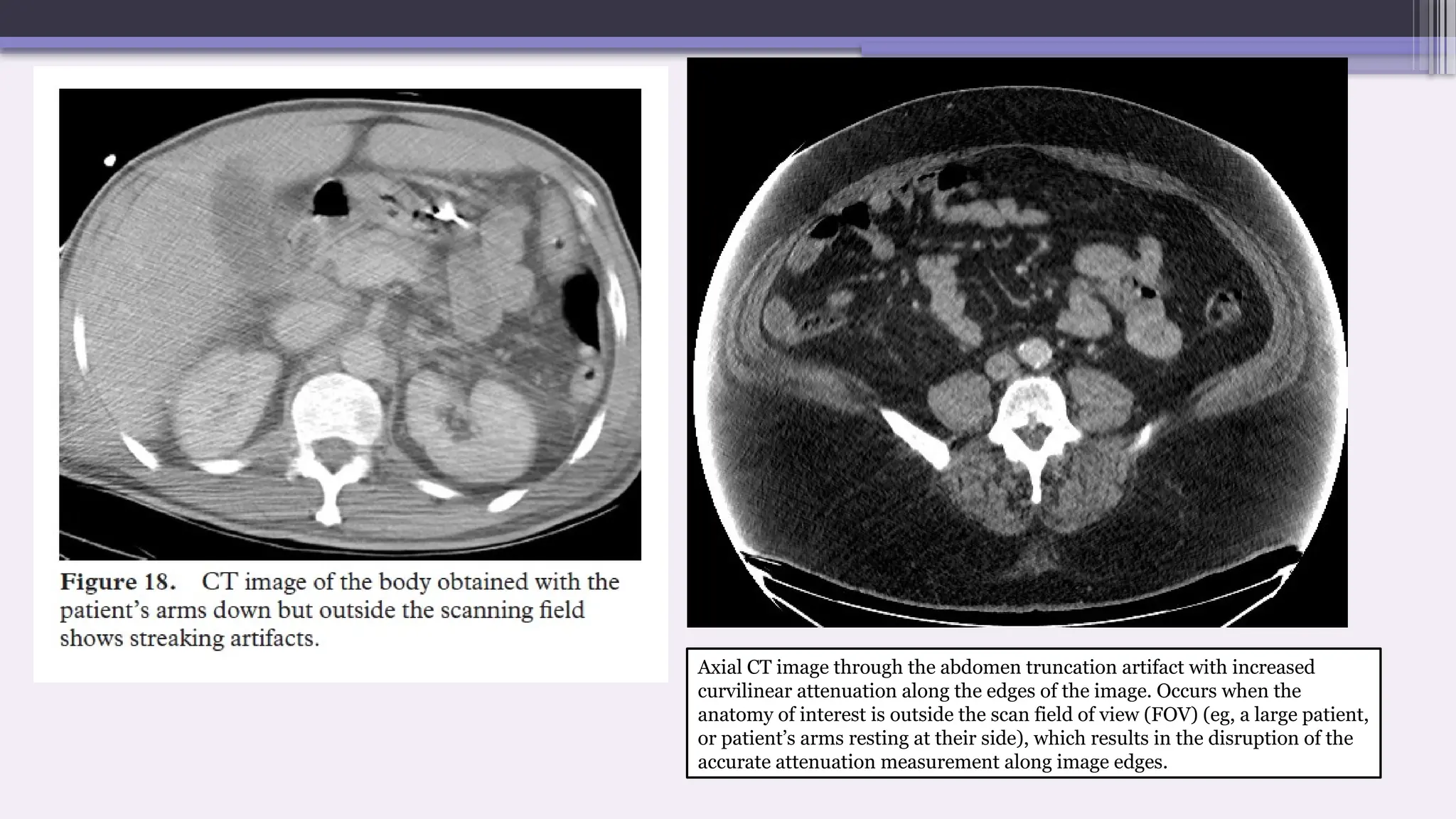 Axial CT image through the abdomen truncation artifact with increased
curvilinear attenuation along the edges of the image. Occurs when the
anatomy of interest is outside the scan field of view (FOV) (eg, a large patient,
or patient’s arms resting at their side), which results in the disruption of the
accurate attenuation measurement along image edges.
 