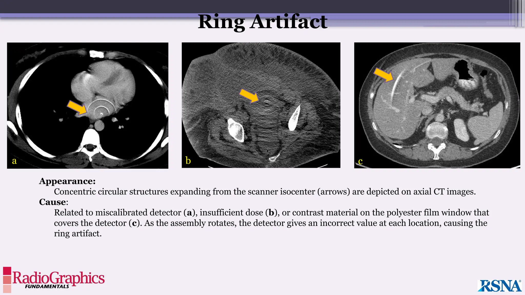 Appearance:
Concentric circular structures expanding from the scanner isocenter (arrows) are depicted on axial CT images.
Cause:
Related to miscalibrated detector (a), insufficient dose (b), or contrast material on the polyester film window that
covers the detector (c). As the assembly rotates, the detector gives an incorrect value at each location, causing the
ring artifact.
Ring Artifact
a b c
 