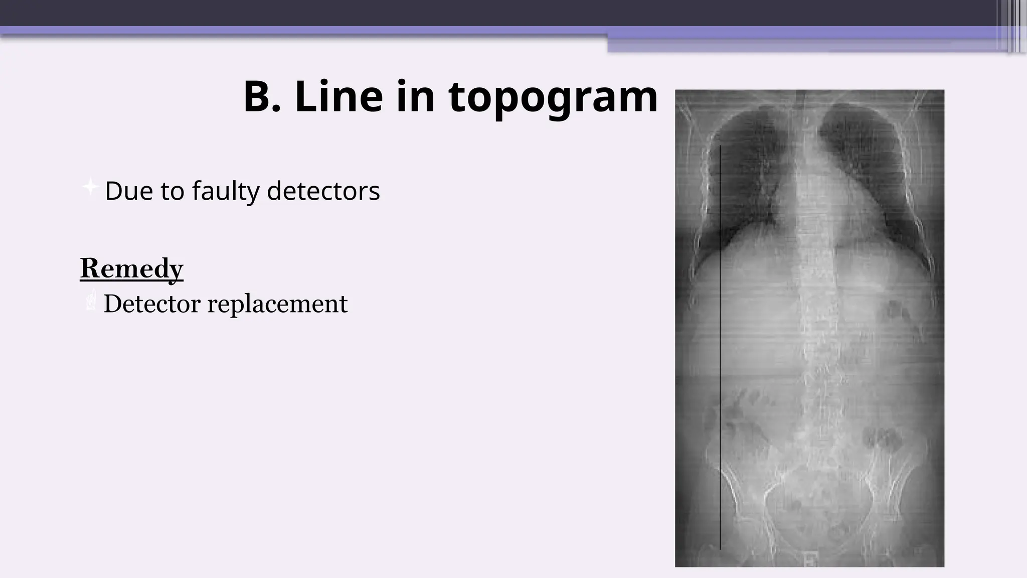 B. Line in topogram
Due to faulty detectors
Remedy
Detector replacement
 