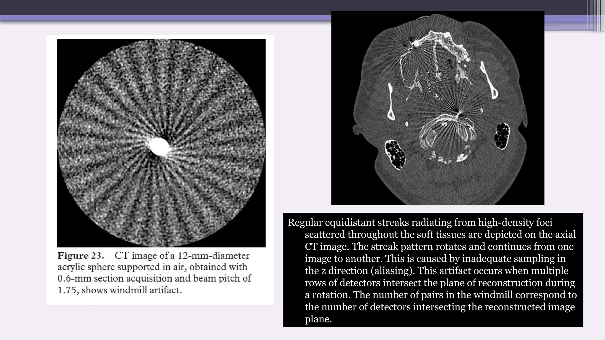 Regular equidistant streaks radiating from high-density foci
scattered throughout the soft tissues are depicted on the axial
CT image. The streak pattern rotates and continues from one
image to another. This is caused by inadequate sampling in
the z direction (aliasing). This artifact occurs when multiple
rows of detectors intersect the plane of reconstruction during
a rotation. The number of pairs in the windmill correspond to
the number of detectors intersecting the reconstructed image
plane.
 