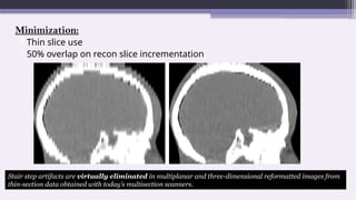 Minimization:
Thin slice use
50% overlap on recon slice incrementation.
Stair step artifacts are virtually eliminated in multiplanar and three-dimensional reformatted images from
thin-section data obtained with today’s multisection scanners.
 