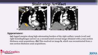 Appearance:
(a) Jagged margins along high-attenuating borders of the right axillary vessels (oval) and
right hemidiaphragm (arrow) on a reconstructed coronal image obtained with 5-mm section
thickness axial acquisitions. (b) This resolved on image b, which was reconstructed from 2-
mm section thickness axial acquisitions.
Stair-step Artifact
a b
 
