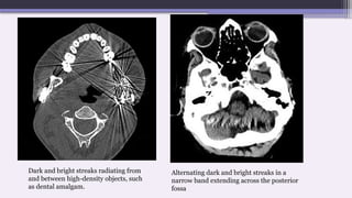 Dark and bright streaks radiating from
and between high-density objects, such
as dental amalgam.
Alternating dark and bright streaks in a
narrow band extending across the posterior
fossa
 
