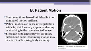 B. Patient Motion
Short scan times have diminished but not
eliminated motion artifacts.
Patient motion can cause misregistration
artifacts, which usually appear as shading
or streaking in the reconstructed image.
Steps can be taken to prevent voluntary
motion, but some involuntary motion may
be unavoidable during body scanning.
 
