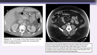 Axial CT image through the abdomen truncation artifact with increased
curvilinear attenuation along the edges of the image. Occurs when the
anatomy of interest is outside the scan field of view (FOV) (eg, a large patient,
or patient’s arms resting at their side), which results in the disruption of the
accurate attenuation measurement along image edges.
 