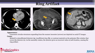 Appearance:
Concentric circular structures expanding from the scanner isocenter (arrows) are depicted on axial CT images.
Cause:
Related to miscalibrated detector (a), insufficient dose (b), or contrast material on the polyester film window that
covers the detector (c). As the assembly rotates, the detector gives an incorrect value at each location, causing the
ring artifact.
Ring Artifact
a b c
 
