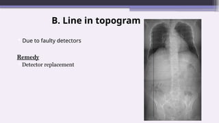 B. Line in topogram
Due to faulty detectors
Remedy
Detector replacement
 