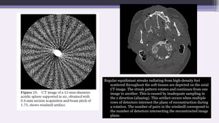 Regular equidistant streaks radiating from high-density foci
scattered throughout the soft tissues are depicted on the axial
CT image. The streak pattern rotates and continues from one
image to another. This is caused by inadequate sampling in
the z direction (aliasing). This artifact occurs when multiple
rows of detectors intersect the plane of reconstruction during
a rotation. The number of pairs in the windmill correspond to
the number of detectors intersecting the reconstructed image
plane.
 
