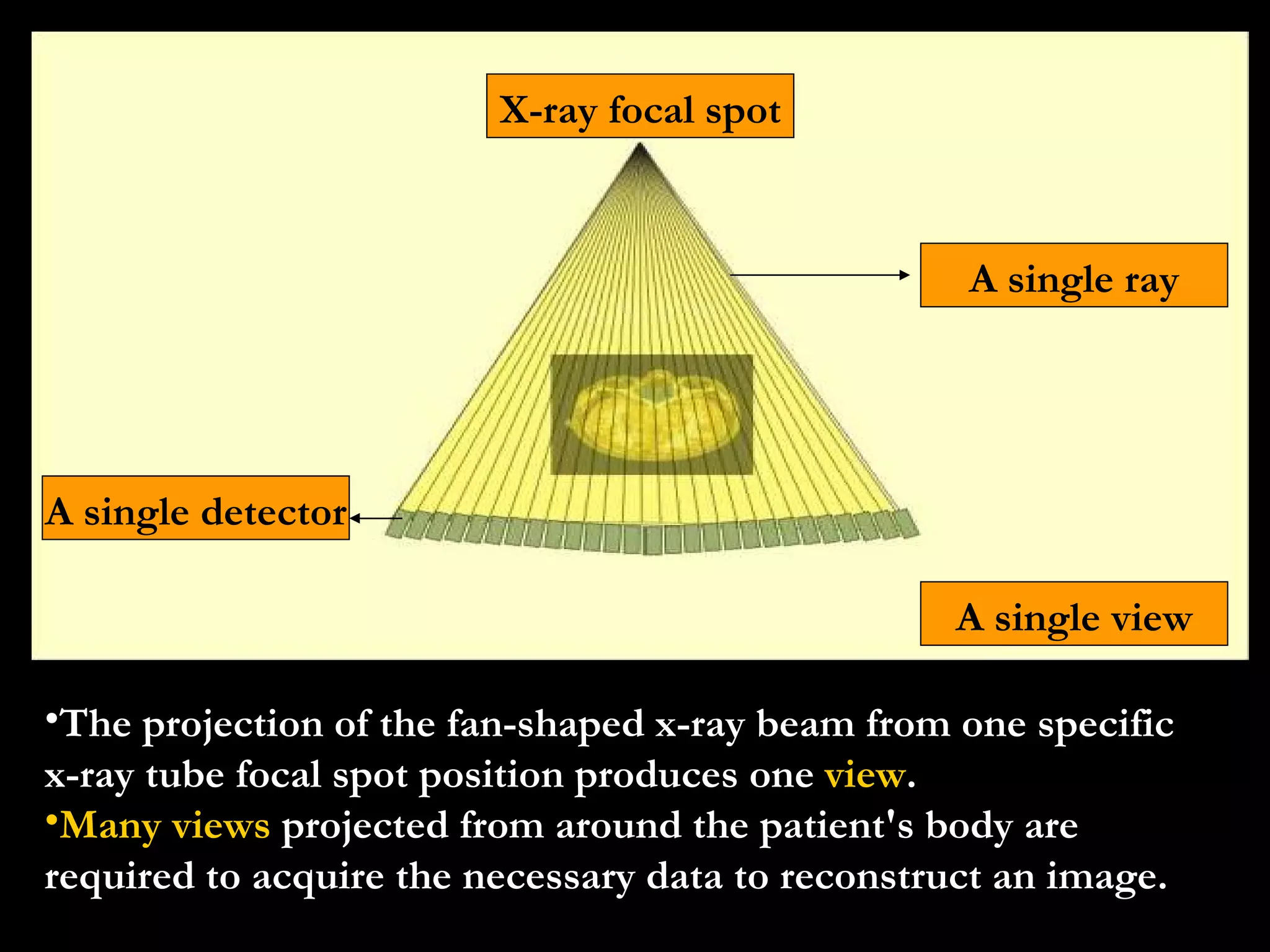 The projection of the fan-shaped x-ray beam from one specific x-ray tube focal spot position produces one  view . Many views  projected from around the patient's body are required to acquire the necessary data to reconstruct an image. A Single view Single ray Single detector X-ray focal spot A single detector A single ray X-ray focal spot A single view 