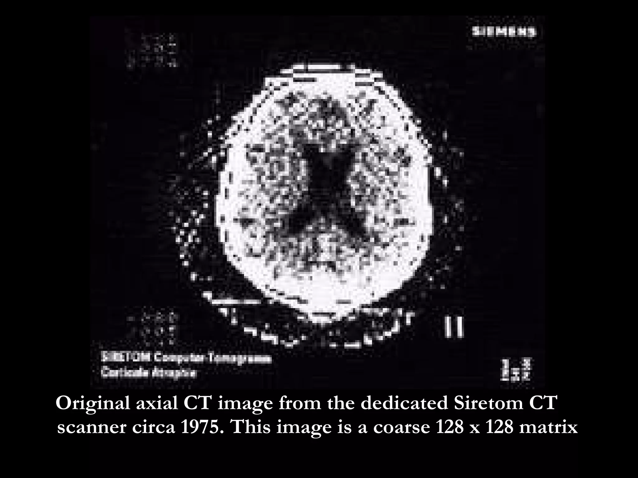 Original axial CT image from the dedicated Siretom CT scanner circa 1975. This image is a coarse 128 x 128 matrix  