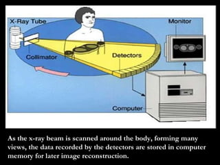As the x-ray beam is scanned around the body, forming many views, the data recorded by the detectors are stored in computer memory for later image reconstruction.   