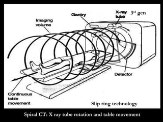 Spiral CT: X ray tube rotation and table movement 3 rd  gen Slip ring technology 