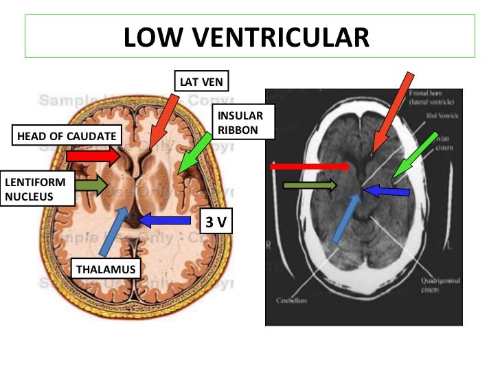 Ct basics