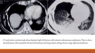 CT axial section contrast study shows displaced right rib fracture with extensive subcutaneous emphysema. There is also a
sternal fracture with associated retrosternal hematoma and lung window settings shows a large right pneumothorax.
 