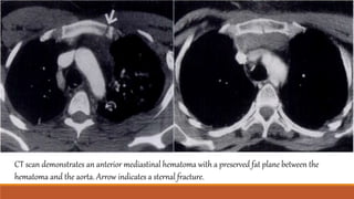 CT scan demonstrates an anterior mediastinal hematoma with a preserved fat plane between the
hematoma and the aorta. Arrow indicates a sternal fracture.
 