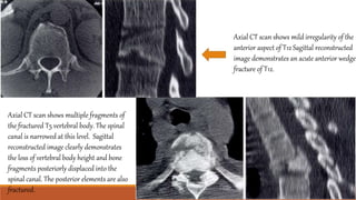 Axial CT scan shows mild irregularity of the
anterior aspect of T12 Sagittal reconstructed
image demonstrates an acute anterior wedge
fracture of T12.
Axial CT scan shows multiple fragments of
the fractured T5 vertebral body. The spinal
canal is narrowed at this level. Sagittal
reconstructed image clearly demonstrates
the loss of vertebral body height and bone
fragments posteriorly displaced into the
spinal canal. The posterior elements are also
fractured.
 