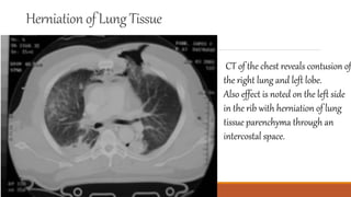 Herniation of Lung Tissue
CT of the chest reveals contusion of
the right lung and left lobe.
Also effect is noted on the left side
in the rib with herniation of lung
tissue parenchyma through an
intercostal space.
 
