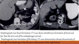 Diaphragmatic tear bowel herniation. CT scan shows intrathoracic herniation of bowel and
fat. Note the torn end of the midiaphragm (arrow).
Diaphragmatic tear herniation of the kidney. CT scan demonstrates abrupt discontinuity of
the right hemidiaphragm. Note the poor enhancement of the right kidney.
 
