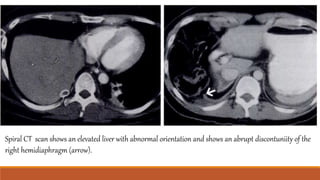 Spiral CT scan shows an elevated liver with abnormal orientation and shows an abrupt discontuniity of the
right hemidiaphragm (arrow).
 