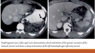 Diaphragmatic tear (collar sign)-scan demonstrates a focal indentation of the greater curvature of the
stomach (arrow) and shows a sharp termination of the left hemidiaphragm inferiorly (arrow).
 