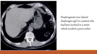 Diaphragmatic tear (absent
diaphragm sign) in a patient who
had been involved in a motor
vehicle accident 5 years earlier.
 
