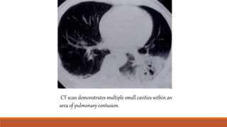CT scan demonstrates multiple small cavities within an
area of pulmonary contusion.
 